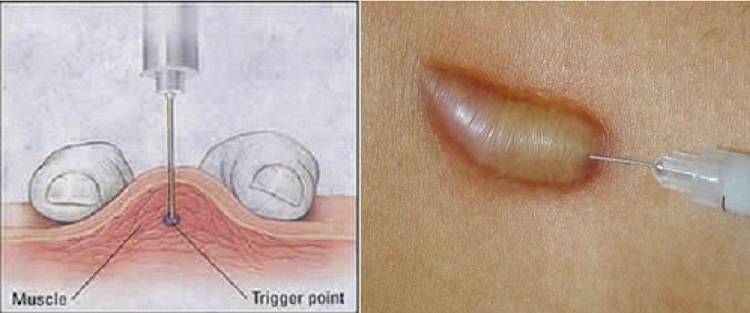 Sẹo lồi là gì? Nguyên cớ và liệu pháp chữa trị sẹo lồi hiệu quả