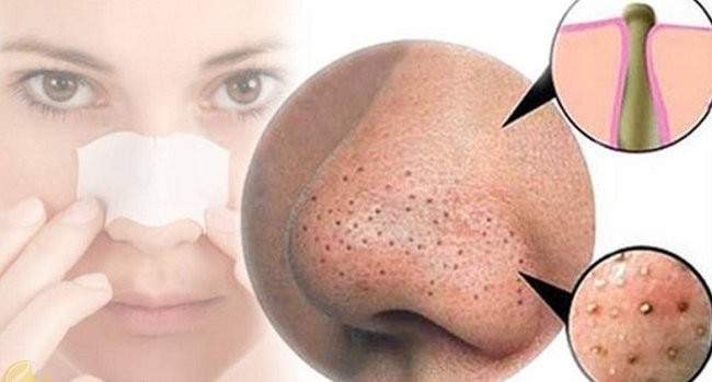 Các cách trị mụn đầu đen an toàn