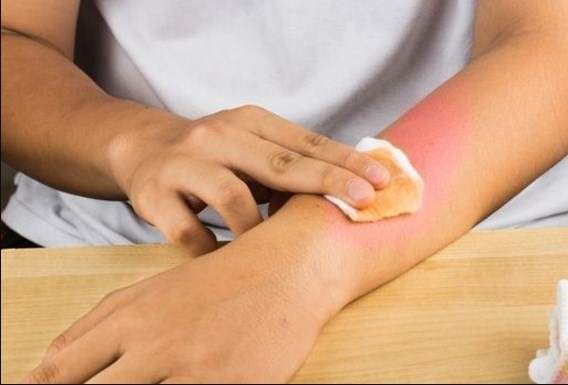Cách sơ cứu nhanh khi bị bỏng dầu ăn