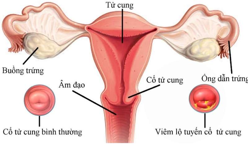 Viêm lộ tuyến cổ tử cung - nguyên nhân và cách phòng ngừa