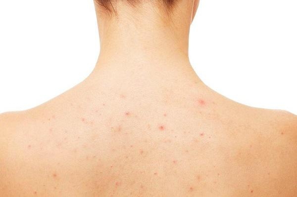 7 cách trị mụn lưng bằng nguyên liệu thiên nhiên, ai không biết t