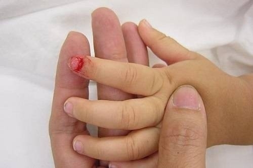 Cách sơ cứu trẻ bị dập ngón tay, ngón chân