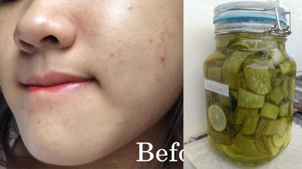 2 cách trị mụn ẩn tại nhà hiệu quả nhất, thay thế cả đống mỹ phẩm