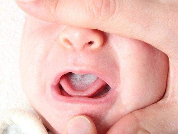 Nguyên nhân gây nhiệt miệng lưỡi ở trẻ và cách chữa trị nhanh kịp
