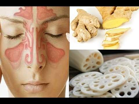 Điều trị tận gốc viêm mũi dị ứng bằng các bài thuốc dân gian