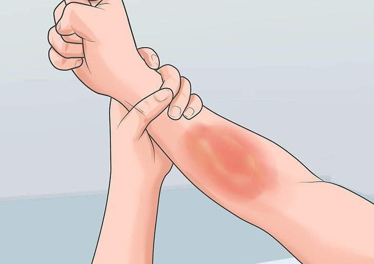 Cháy nắng và cách xử trí