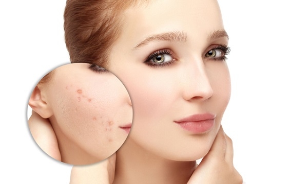Cách trị mụn ẩn dưới da cực kỳ hiệu quả