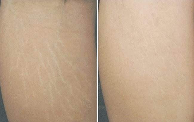 CÁCH CHỮA RẠN DA Ở TUỔI DẬY THÌ CỰC ĐƠN GIẢN