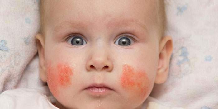 Cách chữa chàm sữa cho bé hiệu quả từ chuyên gia