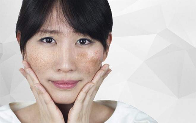 Bật mí cách trị nám cho các mẹ sau sinh cực hiệu quả