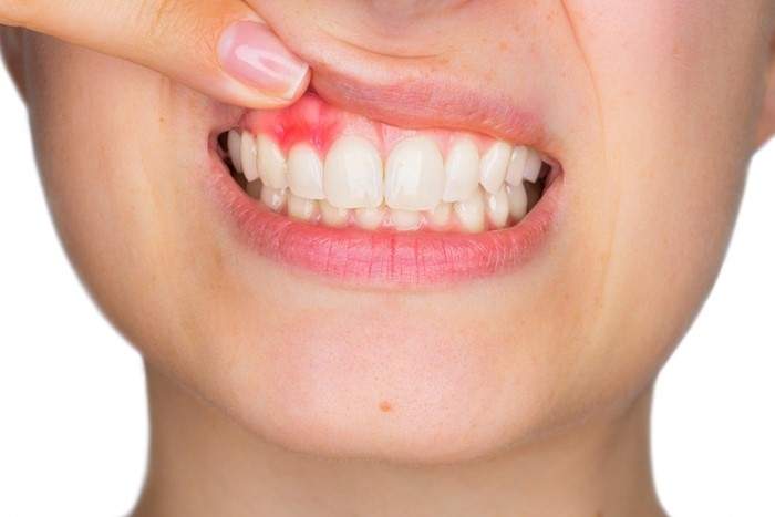 Chữa viêm lợi hiệu quả bằng các thực phẩm hằng ngày