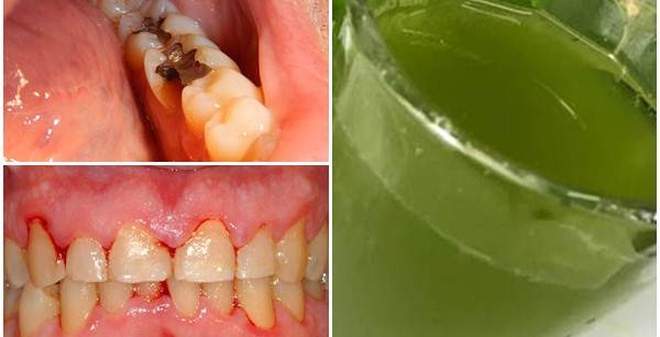 Bài thuốc chữa bệnh răng miệng