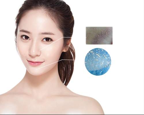 Mẹo hay trị ngay mụn cám hiệu quả